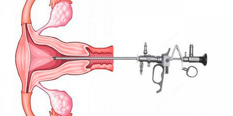 histeroskopi ve tekrarlayan gebelikler