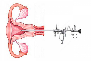 histeroskopi ve tekrarlayan gebelikler
